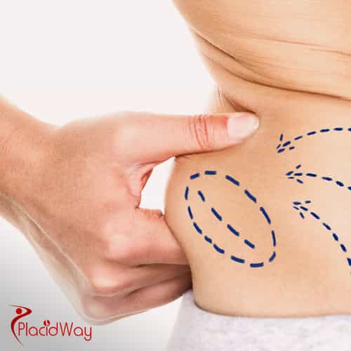 Fettabsaugung in der Türkei: Warum deutsche Touristen sich für eine Laser-Fettabsaugung zur Körperformung entscheiden